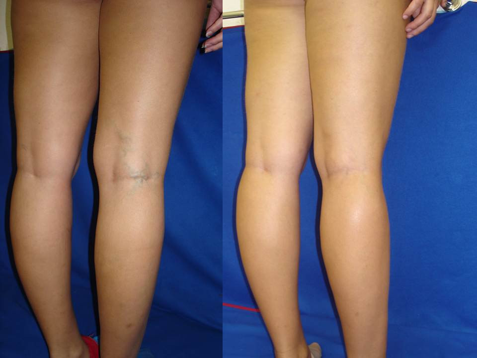 Лазерне видалення вен на ногах у Києві: коли варто звернутися до лікаря